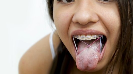 crystal way recommends braces blow job pic